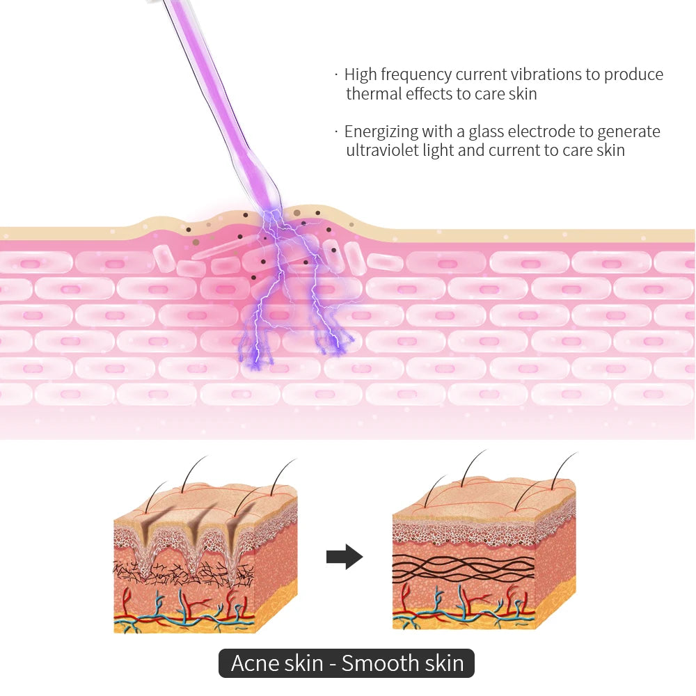 Illustration of a glass wand emitting purple light onto skin layers, showing the transition from acne to smooth skin.