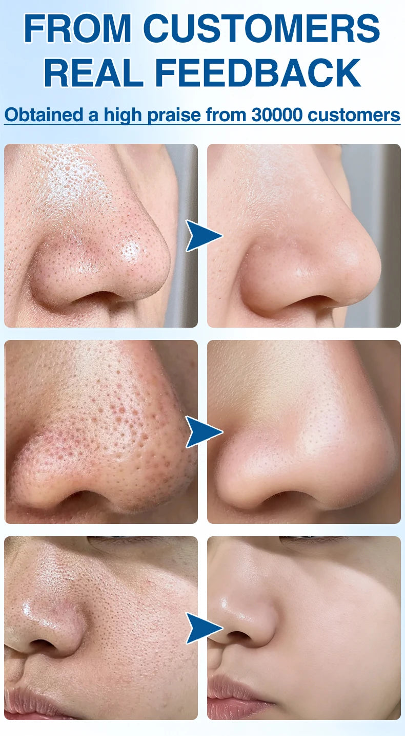 Before and after results of blackhead remover pore vacuum showing clear, smooth skin on noses and faces.