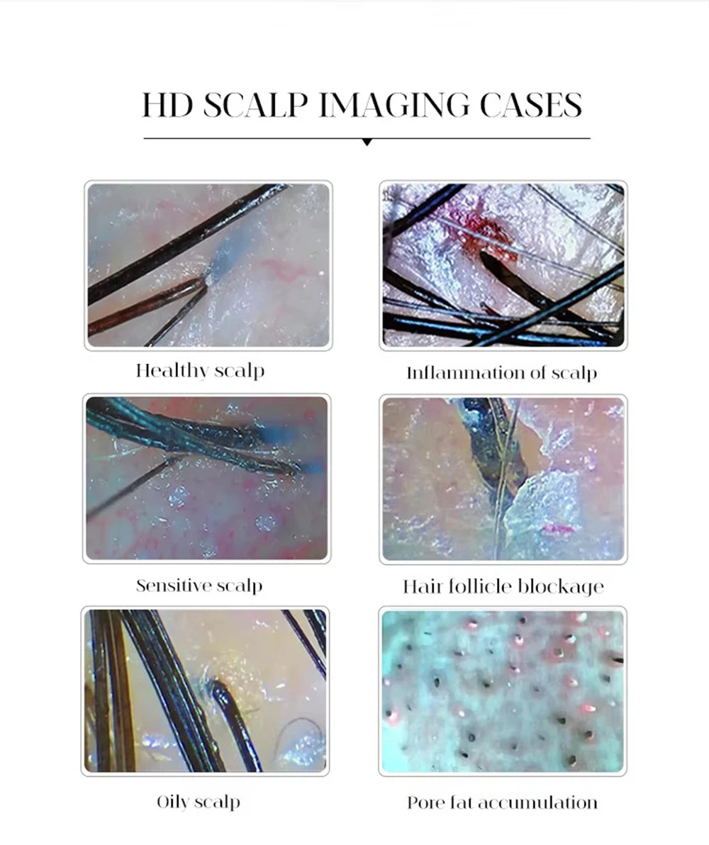 HD scalp microscope analysis showing healthy, inflamed, sensitive skin, follicle blockage, and oily scalp conditions.