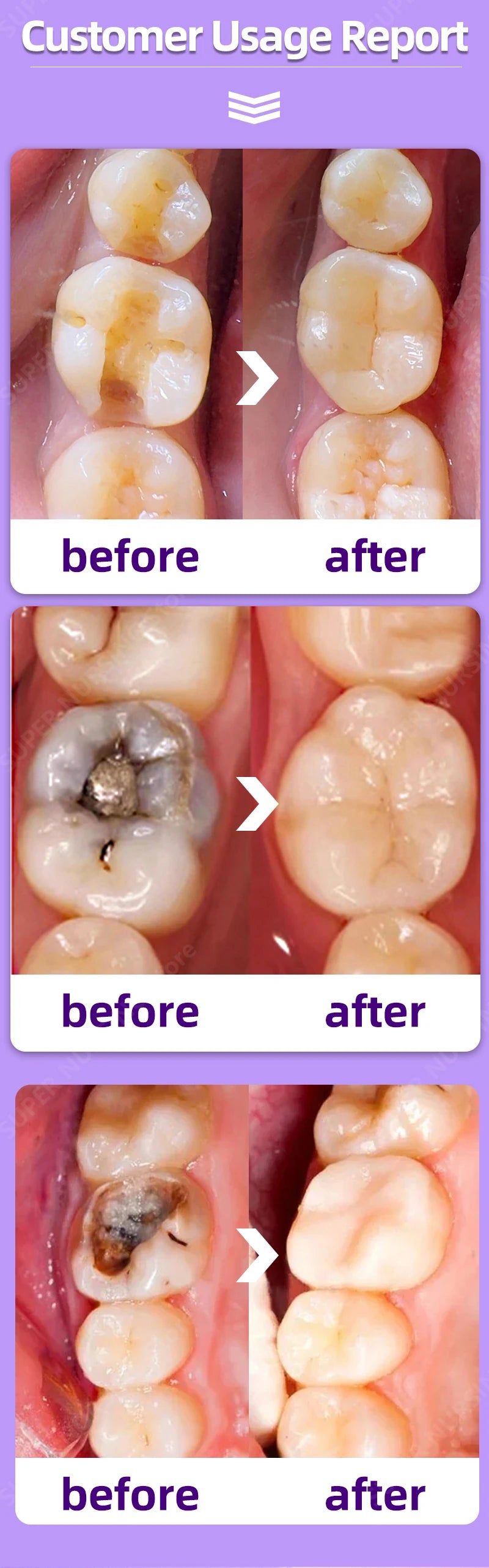 Tidesmit anti-caries teeth whitening treatment for healing cavities and enamel repair