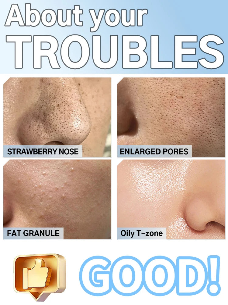 Skin issues like strawberry nose, enlarged pores, acne, and oily T-zone treated by electric blackhead vacuum remover.