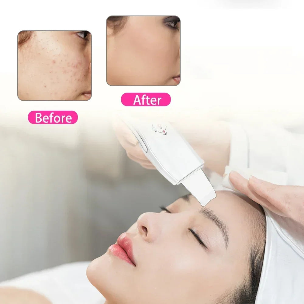 Ultrasonic Skin Scrubber | Deep Pore Cleaning Tool | USB Rechargeable Scrubs Treatments Tidesmit