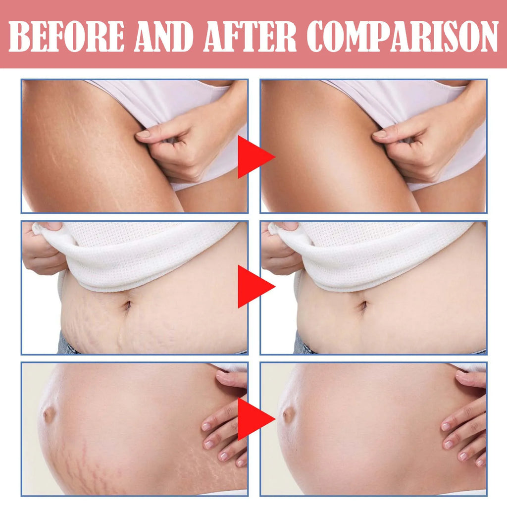 2026 Stretch Mark Removal Cream Permanently Removes Stretch Marks Rejuvenates Skin Stretch Mark Removal Cream.