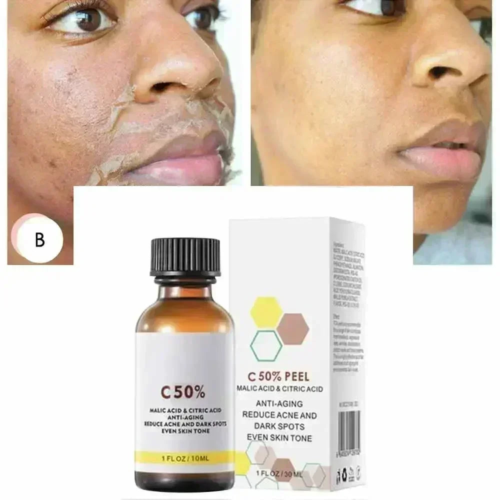 Salicylic Acid Peeling Lotion for Dark Skin | Professional Exfoliation Scrubs Treatments Tidesmit