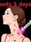 Blue Light Wart Removal Pen - Painless Portable Skin Tag Tool Massage Roller Pack of 1Pcs Tidesmit