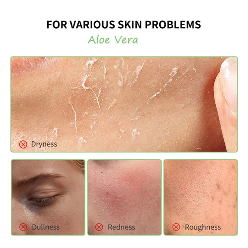Aloe vera face gel applied to skin, with dryness, dullness, redness, and roughness tiles.
