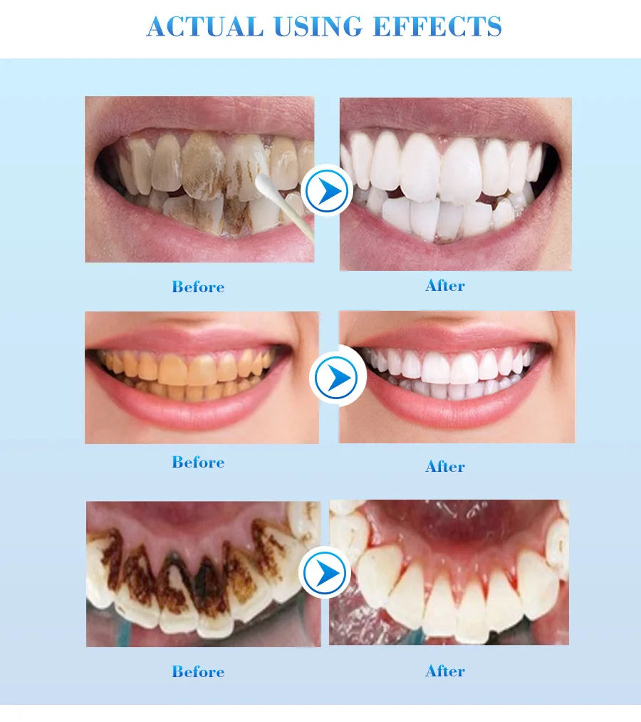 Tidesmit teeth whitening serum gel for removing plaque and yellow smoke stains for brighter smile