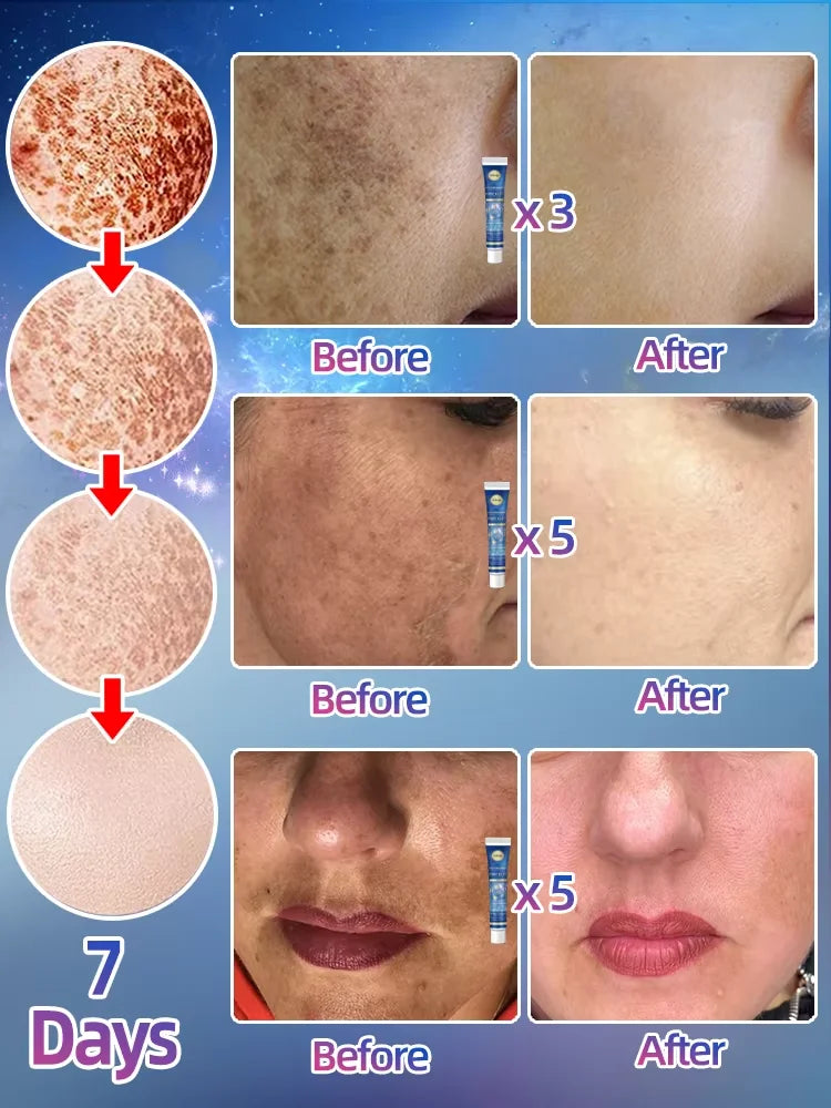 Before and after photos showing a skin lightening cream in a blue tube used to reduce dark spots and even skin tone.