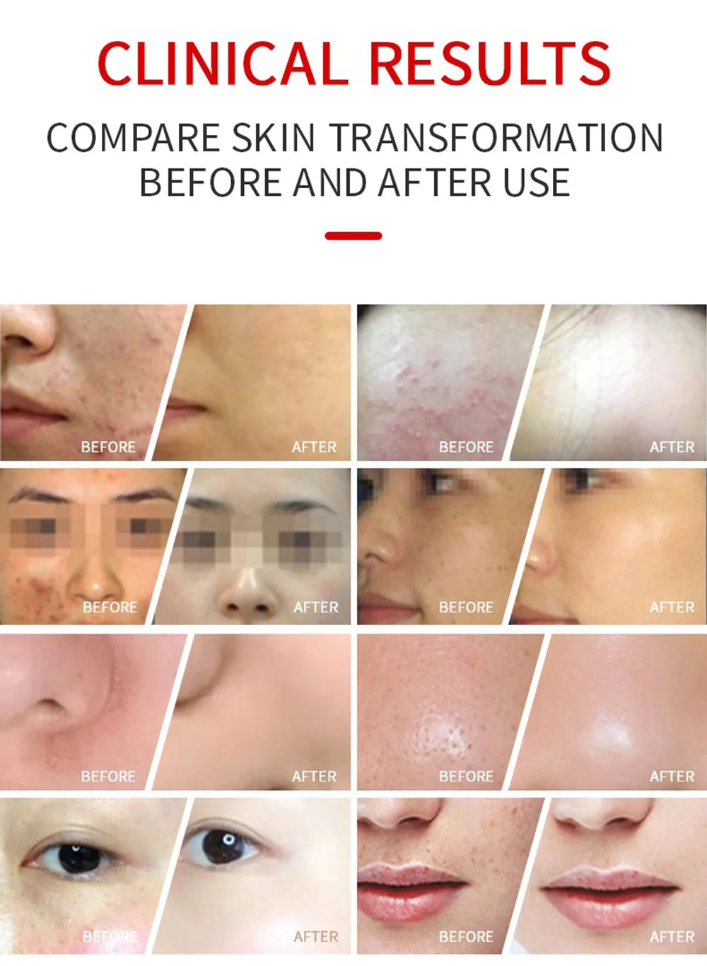 A clinical results grid showing skin before-and-after comparisons of acne, blemishes, and texture improvements.