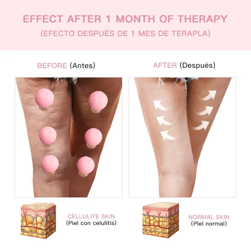 Before and after comparison of pink silicone vacuum cupping tools on skin to reduce cellulite.