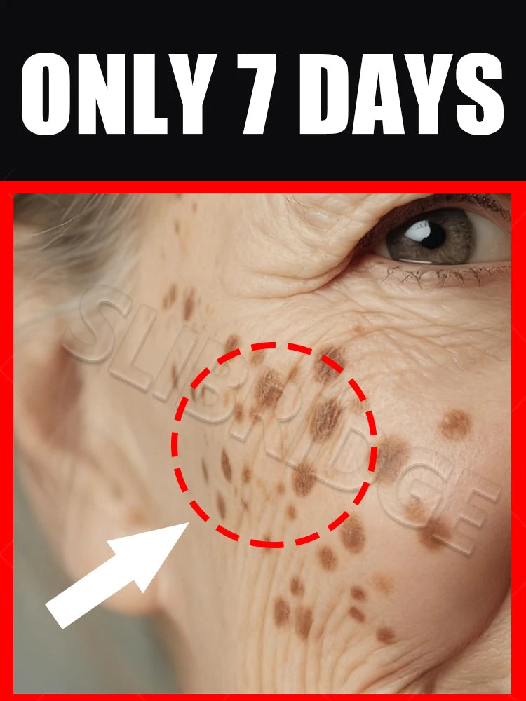 Close-up of skin with dark spots, highlighted by a red dashed circle and arrow, with text saying "ONLY 7 DAYS."