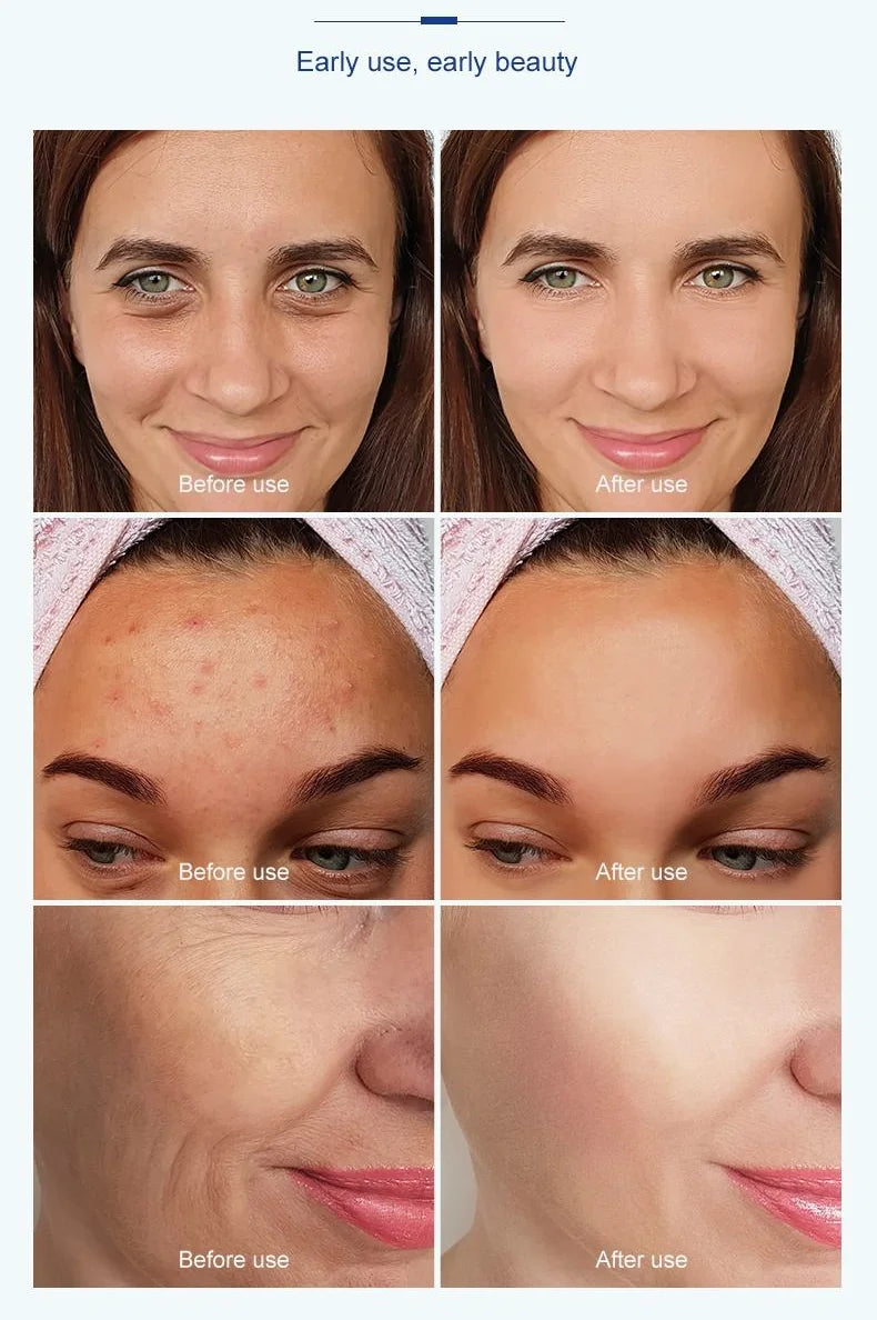 Before and after results using 3in1 nano vacuum mesotherapy gun for facial lifting, acne, and wrinkle removal.