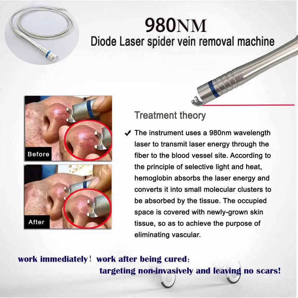 980nm diode laser device for painless spider vein removal, featuring metal handpiece and before-after skin treatment.