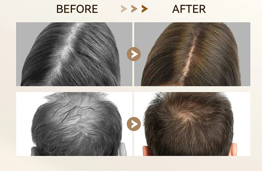 Before and after hair growth results using an adjustable microneedling derma stamp pen for hair and beard regrowth.