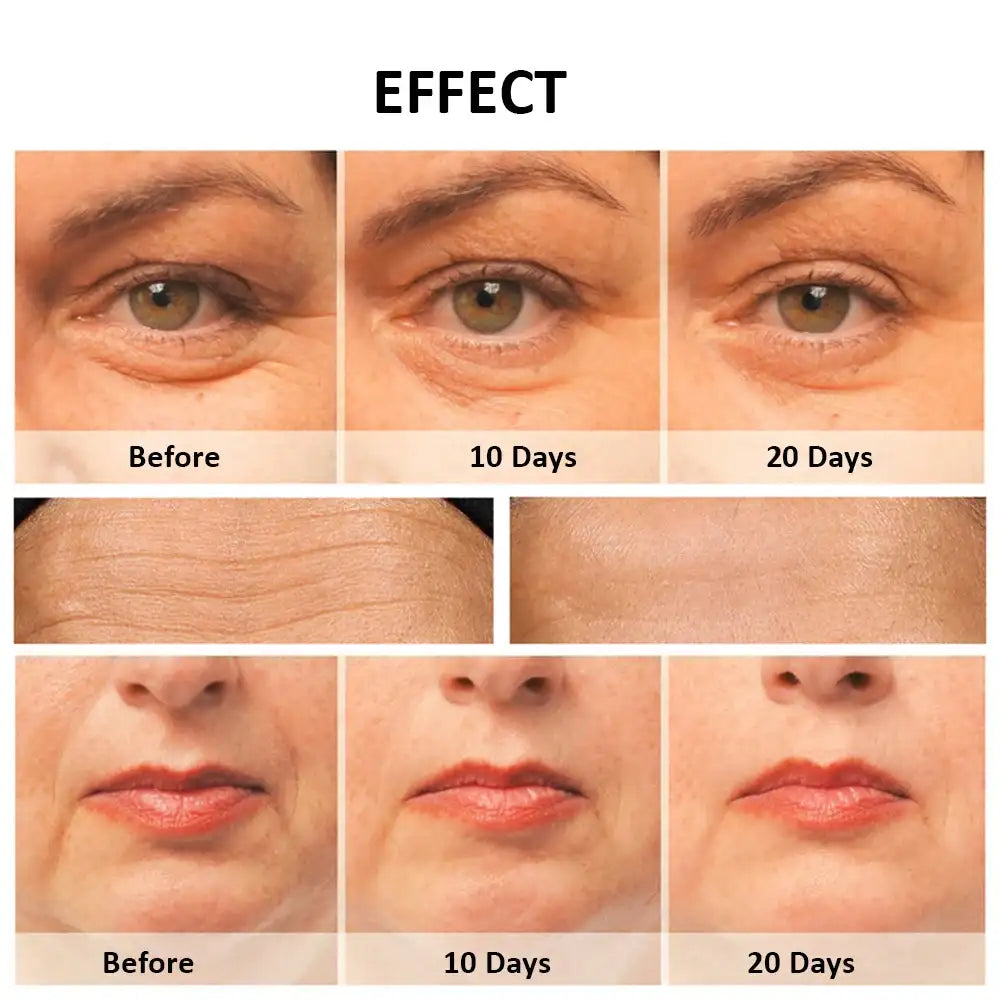 Before and after comparison of facial skin showing reduction in wrinkles and fine lines over 20 days of treatment.