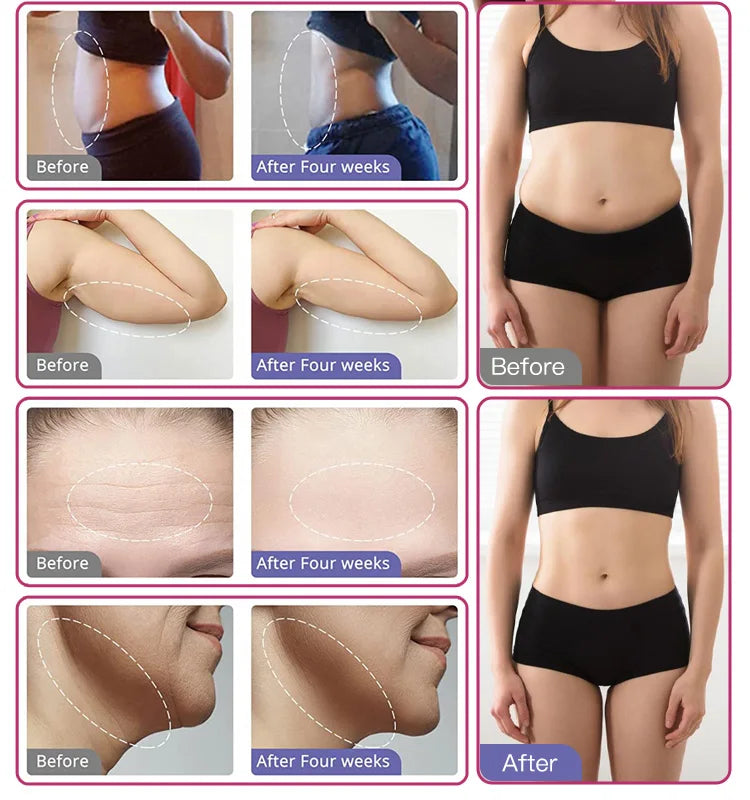 Before and after results of 6-in-1 ultrasonic cavitation machine for body sculpting, fat loss, and skin tightening.
