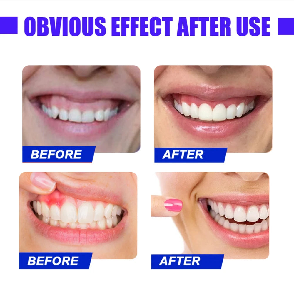 Gum Disease Red Light Therapy Device - HLKGO-USBO3 Oral Wellness Relaxation Treatment Tidesmit