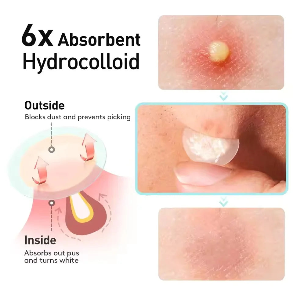 360/720/1080 Tea Tree Oil Acne Patch - Effectively removes acne patches, alcohol free, odorless, suitable for all skin types