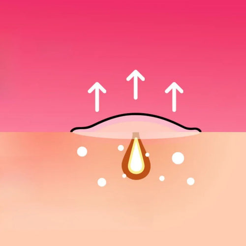 Facial acne patch placement diagram with arrows and water-drop icon