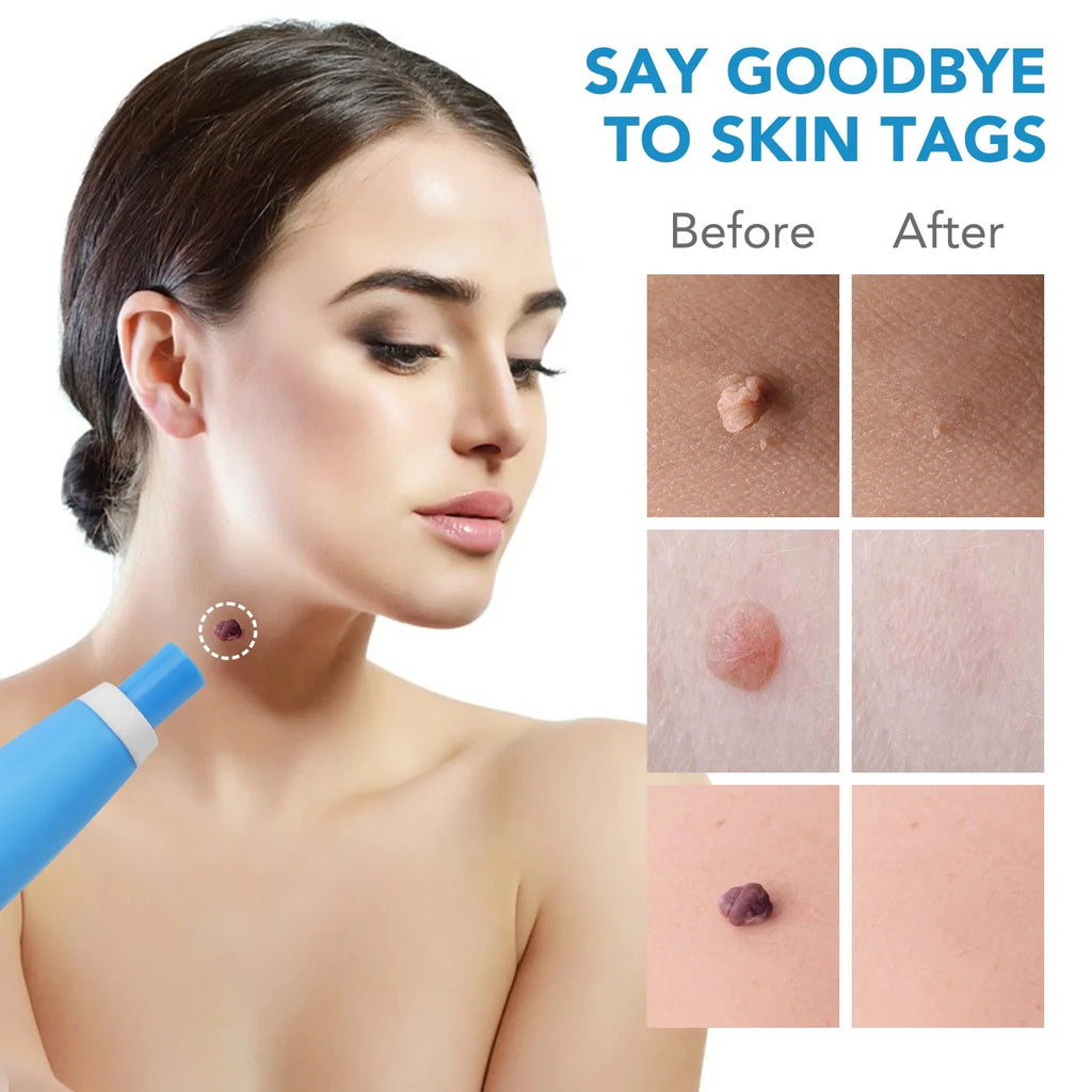 Painless 2-in-1 auto skin tag and mole remover tool for face and body treatment with before and after results.