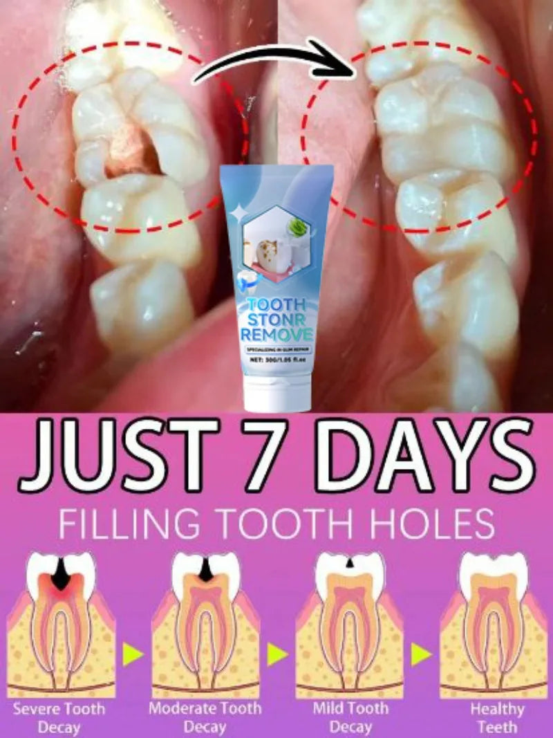 Tidesmit probiotic teeth whitening treatment for tooth decay repair and deep enamel cleaning