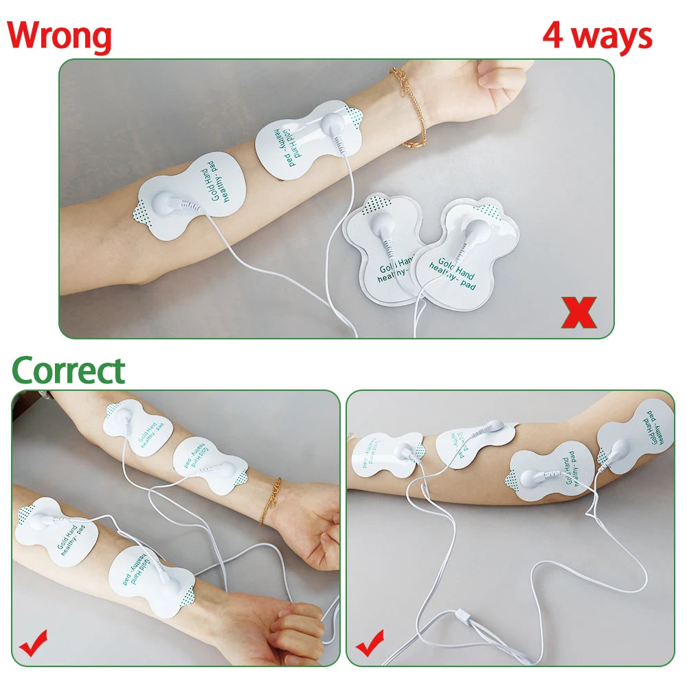 TENS unit electrode pads placed on arm for electric muscle stimulation massage therapy. Proper versus improper usage.
