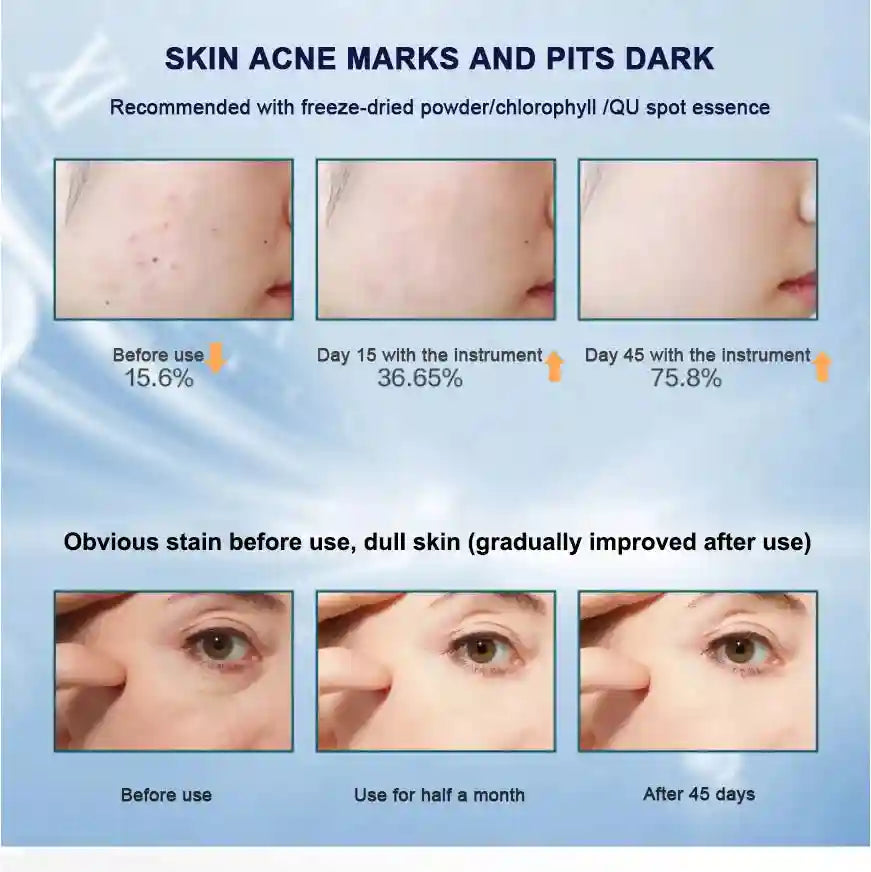 Before and after progress photos showing reduced acne marks, pits, and dark spots on facial skin over 45 days.