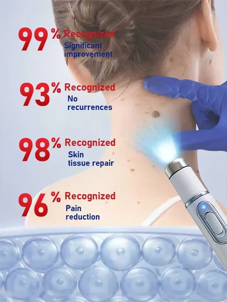 Wart Remover Blue Light Device: Painless Skin Tag Treatment Scrubs Treatments Tidesmit