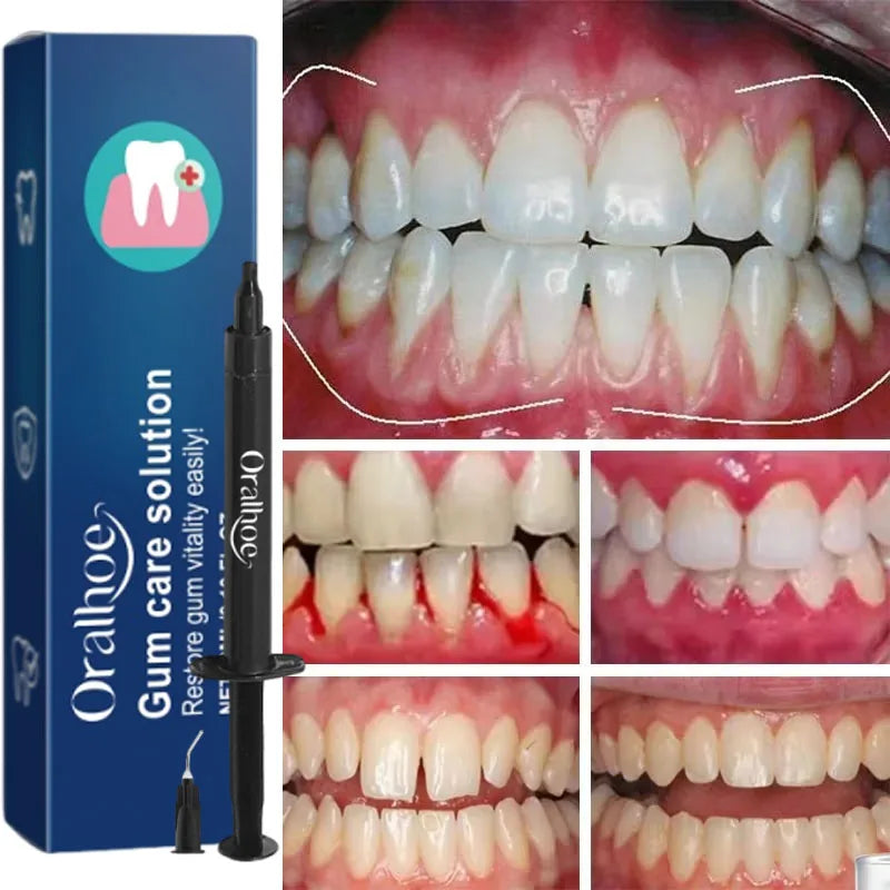 Tidesmit gum repair teeth whitening gel for treating gingival inflammation and removing deep dental stains