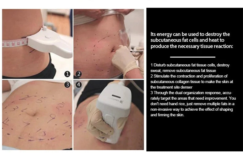 Portable 576-point Liposonic machine for non-invasive fat reduction, body slimming, and skin tightening treatment.