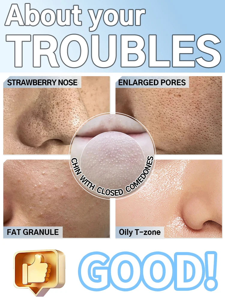 Blackhead remover vacuum tool treating strawberry nose, enlarged pores, fat granules, and oily T-zone skin conditions.