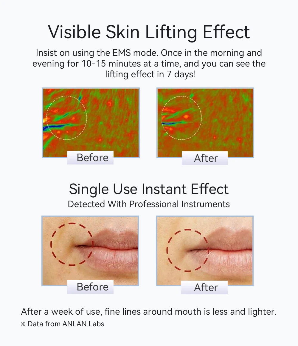 ANLAN EMS facial massager before and after results showing reduced fine lines and visible skin lifting effects.