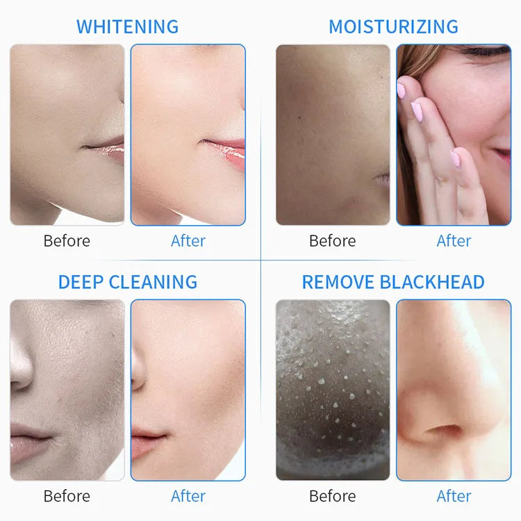 Before and after results of 7-in-1 hydro facial machine for deep skin cleaning, whitening, moisturizing, and pores.