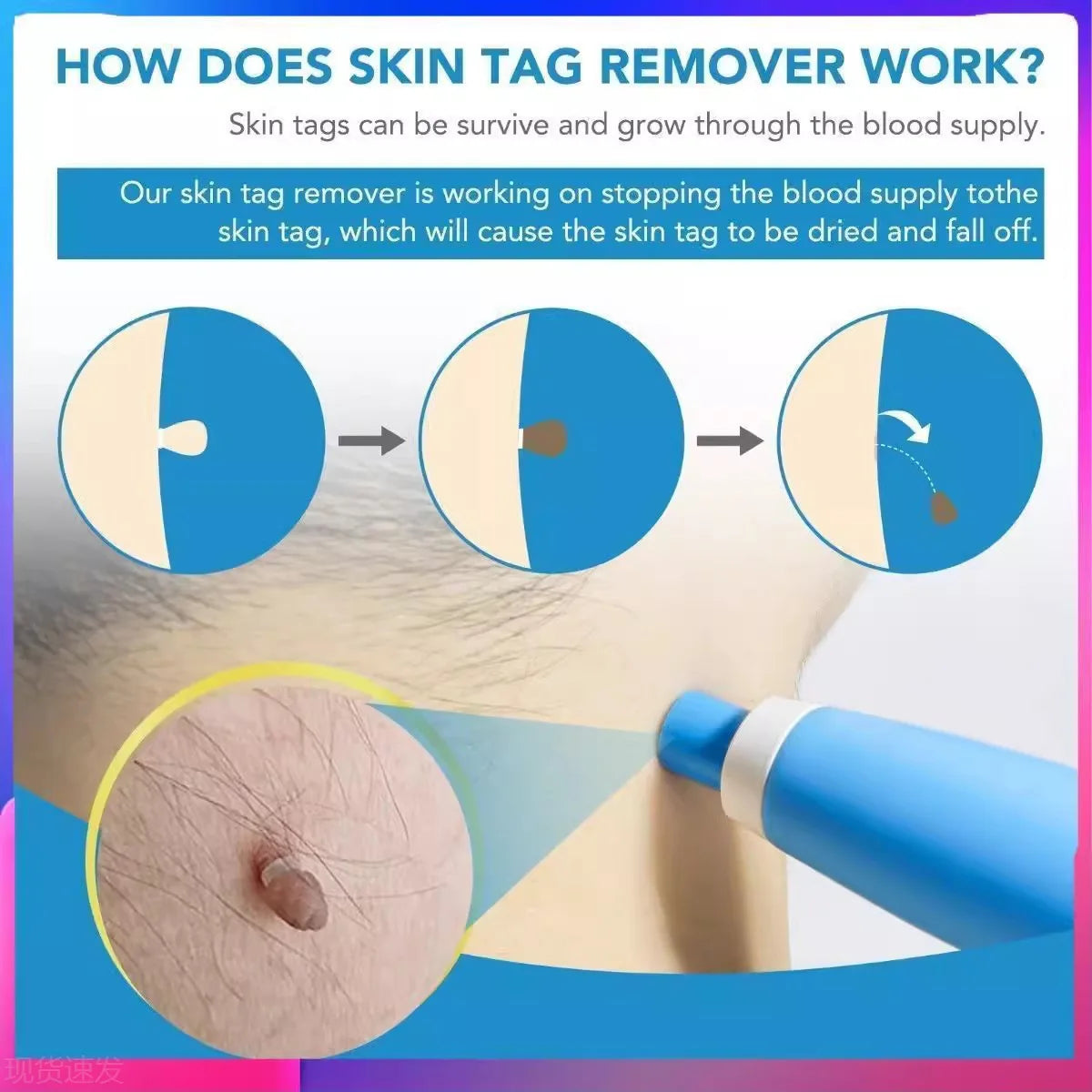 Blue auto skin tag remover pen device showing how to remove moles and warts by cutting off blood supply to the skin.