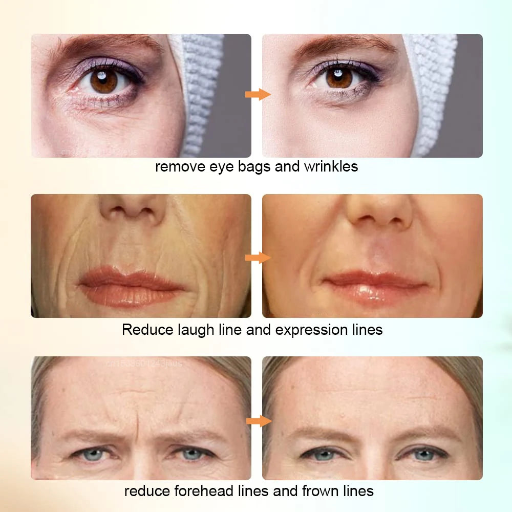 Before and after comparison showing reduced eye bags, smile lines, and forehead wrinkles after facial massager use.