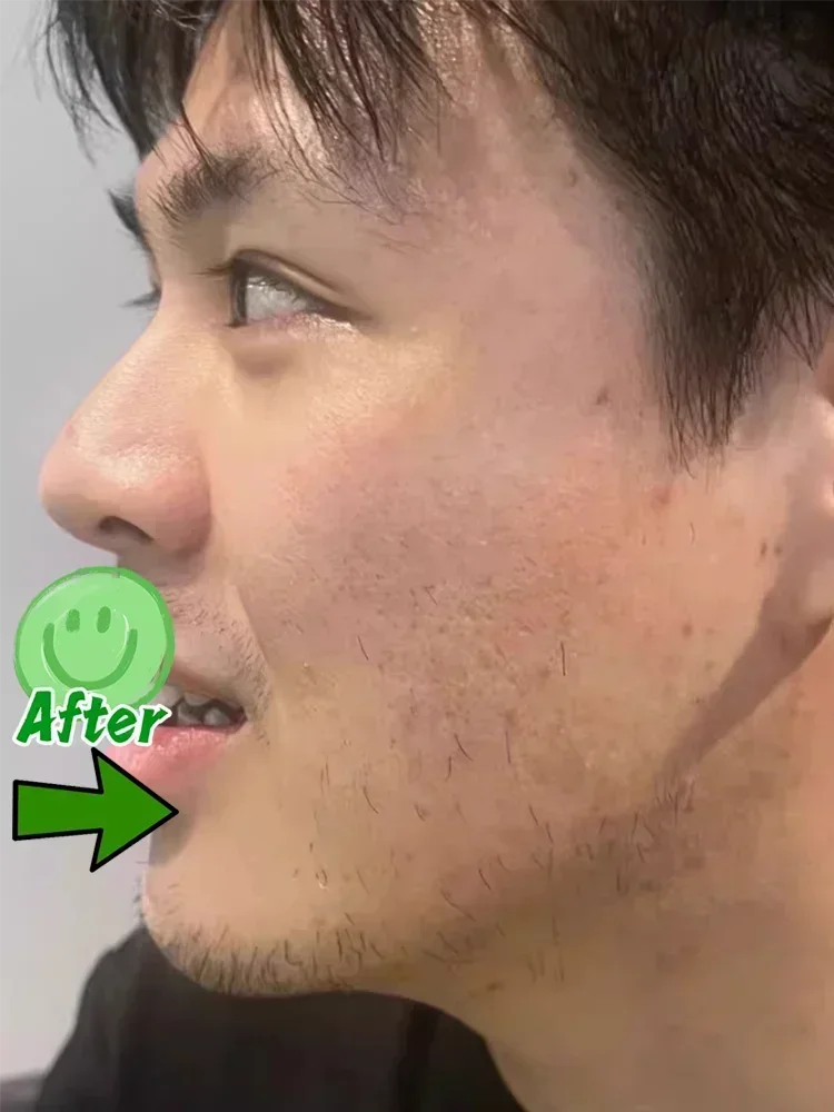 Acne Scar Removal Gel for Men – Professional Pothole Mark Repair Scrubs Treatments Tidesmit