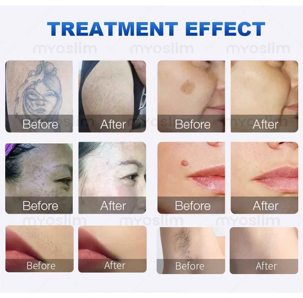 Tidesmit 2-in-1 diode and picosecond laser machine for professional hair, tattoo, and mole removal skin treatment.