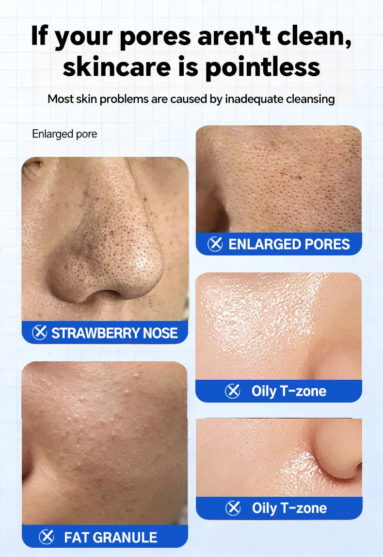 Skin care infographic showing enlarged pores, strawberry nose, oily T-zone, and fat granules for acne removal treatment.